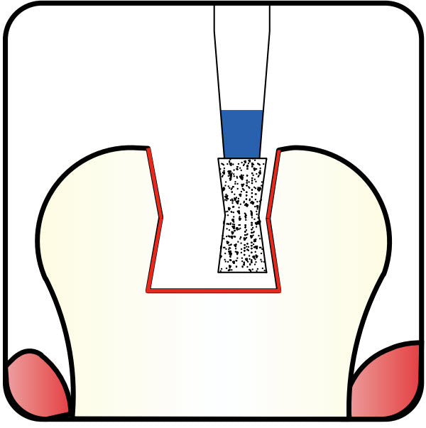 Diabolo 1.5 mm Dia. Medium Grit Diamond Bur 5 per pack. 032.15M1